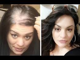 Women typically have a broadening of the part in their hair. How To Hide Thin Balding Head With Hair Topper Uniwigs Youtube