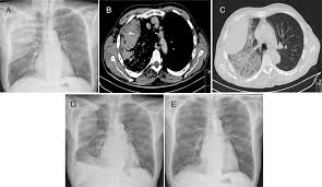 Image result for Pulmonary Contusion