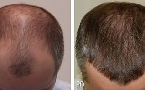 Hair Transplant Cost In Turkey Body Hair Transplant Hair Transplant Price Hair Transplant Cost