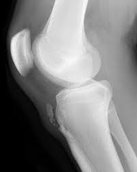 Osgood Schlatter Disease Radiology Reference Article Radiopaedia Org