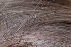 If you have an oily hair then using a whole egg for your hair can help your hair to reap the combined benefits of both egg white and egg yolk. Head Lice Are Equal Opportunity Invaders University Health News