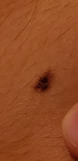 What does melanoma look like? Does This Look Like Melanoma Melanoma