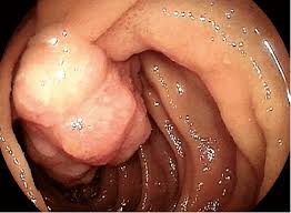 May have recurrent genetic translocations. Hamartoma Of The Jejunum Download Scientific Diagram