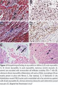 Myocarditis (mk) is a cardiovascular disease characterized by heart muscle damage due to the development of inflammation in the tissues of the organ. Jpma Journal Of Pakistan Medical Association