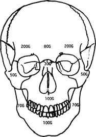 In the neurocranium these are the occipital bone, two temporal bones, two parietal bones, the sphenoid. The Impact Absorbing Effects Of Facial Fractures In Closed Head Injuries In Journal Of Neurosurgery Volume 66 Issue 4 1987