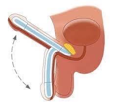 Image result for Penile Prosthesis