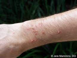 For mosquito or other minor bites, try. Fire Ant Bites American Osteopathic College Of Dermatology Aocd