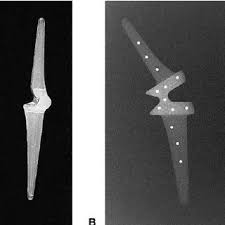 Christian83 i don't know whether to think that article is wishful thinking or not. Pdf Metacarpophalangeal Joint Mechanics After 3 Different Silicone Arthroplasties