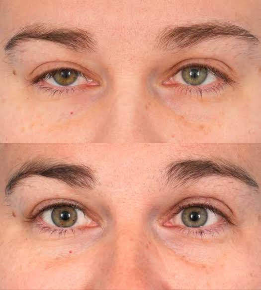 Best Droopy Eyelids Chicago, IL | Chicago Oculofacial Plastic Surgery