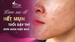 Cách Trị Mụn Tuổi Dậy Thì Đơn Giản Hiệu Quả 2024