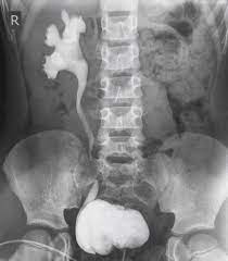 And that's what typically lands people with. Unilateral Vesicoureteric Reflux Radiology Case Radiopaedia Org