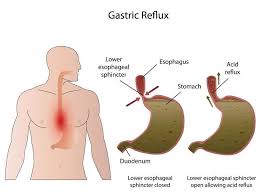 Diagram Of Bile Reflux After Gallbladder Removal Bile Reflux Reflux Heart Burn Remedy