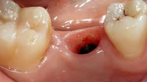 Image result for Alveolitis sicca)