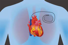 Obviously, i have to go through the metal detector at least twice for each trip. Protecting Implantable Medical Devices From Electromagnetic Interference Passive Components Blog
