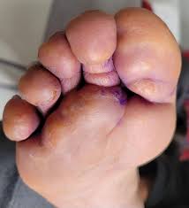 Image result for pompholyx soles of feet