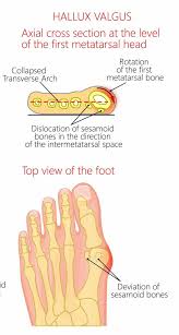 Wear shoes that are flexible and have a wide toe box. Can Bunions Be Reversed Without Surgery Best Home Treatment