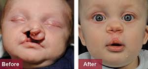 Cleft lip and palate repair surgery is a surgical procedure, which is used to fix problems of the upper lip and palate. Cleft Lip And Palate Shriners Children S Ohio