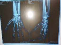 Image result for Hand Growth Plates