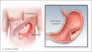 Symptoms of early stomach cancer can be similar to the symptoms of other conditions, such as stomach ulcers. Watch Out This Deadly Stomach Disease Ids Medical Systems News