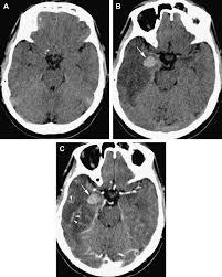 Image result for HSV Encephalitis