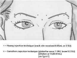 Brow lifting can be accomplished with botox. Figure 7 From Update On Botulinum Toxin For Facial Aesthetics Semantic Scholar