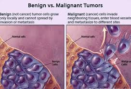 Here's what you should know about your treatment and what to expect going forward. Understanding Cancer Metastasis Stages Of Cancer And More