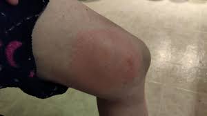Image result for ant bite