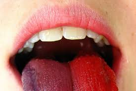 Image result for Taste Dysfunction