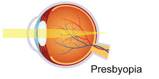 Image result for Presbyopia