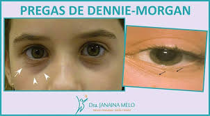 Dupla Linha de Dennie