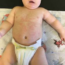 The first time your baby catches the cold sore virus, it will probably give them swollen gums and a sore mouth the sores may be more difficult to see on darker skin, particularly in the early stages. Types Of Baby Rashes Pregnant Chicken