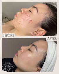 Clear complexion facials