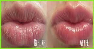 Maybe you would like to learn more about one of these? 10 Amazing Benefits Of Using Glycerin For Lips