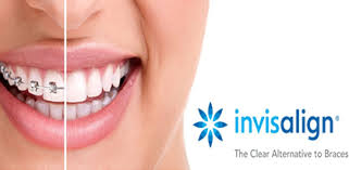 Best reviews, without insurance ok. Clear Aligners Invisalign In Dubai Invisalign Aligners Braces Treatment