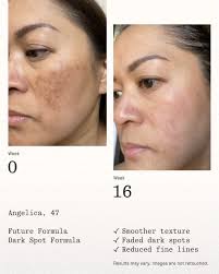 After trying numerous products, Agency is the only one that I have finally  seen a huge improvement in my hyperpigmentation. It's been quite a journey  for me, but I am so close
