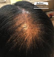 In addition to keloid scars, uterine fibroids and ccca are both fibroproliferative diseases more common in women of african descent that are associated with increased profibrotic gene expression. Got Hair Loss Get A Proper Diagnosis Aglow Dermatology