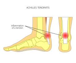 It responds to the simple touch of your finger with a smoother feel and operation. What Is Achilles Tendonitis Podiatrist In Evansville In