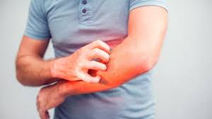 Melihat dampak psikologisnya, banyak cara menghilangkan panu di wajah dan badan dengan cepat menggunakan bahan alami. 7 Bahan Alami Untuk Mengatasi Kulit Gatal Akibat Alergi Hot Liputan6 Com