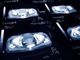 Often, incontinence does not go away on its own. Largest Ever Study Of Prostate Cancer Genomics In Black Men Ids Potential Targets For Precision Therapies Uc San Francisco