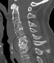 Image result for Spinal Infection