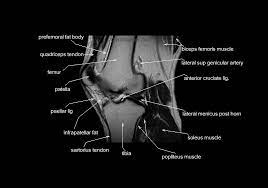 Along the posterior portion of the muscle (yellow arrows), there is a flat area of tendon originating from the knee. Mri Knee Anatomy Knee Sagittal Anatomy Free Cross Sectional Anatomy