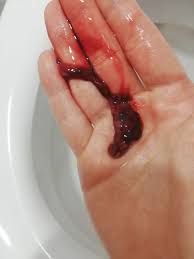 Menstrual flow lasts anywhere from 3 days to 7 days whereas implantation bleeding may only last a few hours. Miscarriage At 6 Weeks Help Please September 2017 Babies Forums What To Expect