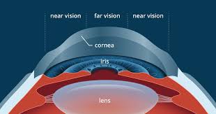 Your results depend on your specific refractive error and other factors. Guide To Presbylasik Multifocal Lasik Bifocal Lasik Or Lasik For Presbyopia
