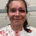 Abbie Ward's battle scars after the Black Ferns match... : r/rugbyunion