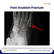 Image result for Foot Fracture