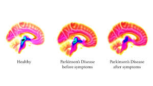 Parkinson's disease is a progressive nervous system disorder that affects movement. Study Reveals Roots Of Parkinson S In The Bra Eurekalert