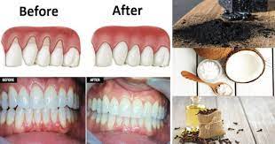 These 10 Natural Remedies Will Help Grow Back Your Receding Gums In No Time Receding Gums Sensitive Teeth Remedy Gum Health