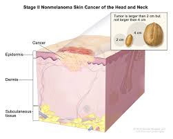The goal of treatment is to kill as many cancerous cells while reducing damage to normal cells nearby. Skin Cancer Types Symptoms Information Dana Farber Cancer Institute Boston Ma