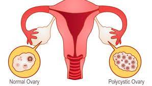 Cara melancarkan dan menghilangkan rasa sakit saat haid datang bulan, cara membuat ramuan alami. Cara Mengatasi Darah Menstruasi Yang Terlalu Banyak