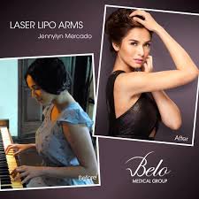 It didn't help that the people behind belo's social media decided deleting comments of criticism under their posts was the. Belo Medical Group On Twitter Jennylyn Mercado Got Her Sculpted Arms In Just 2 Hours Thank To Laser Lipo By Belo Belolaserlipoallstars Http T Co Opvbbgqlyr
